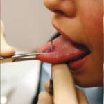 Das Piercen der Zunge - vertikale Technik